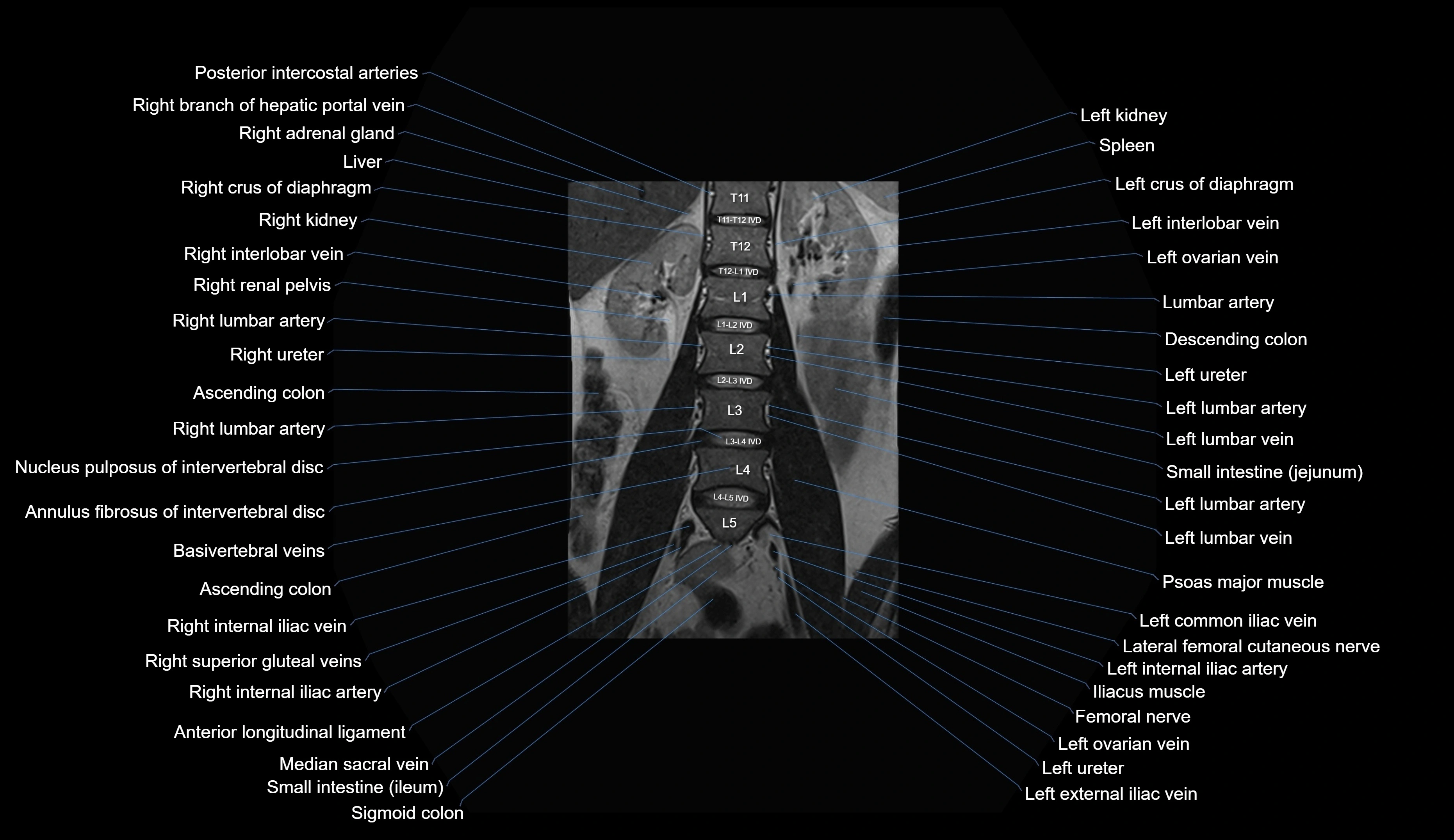 MRI lumbar spine coronal cross sectional anatomy 3T radiology  image-img-00001-00012.webp